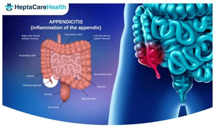 Can appendicitis cause pain during intercourse?