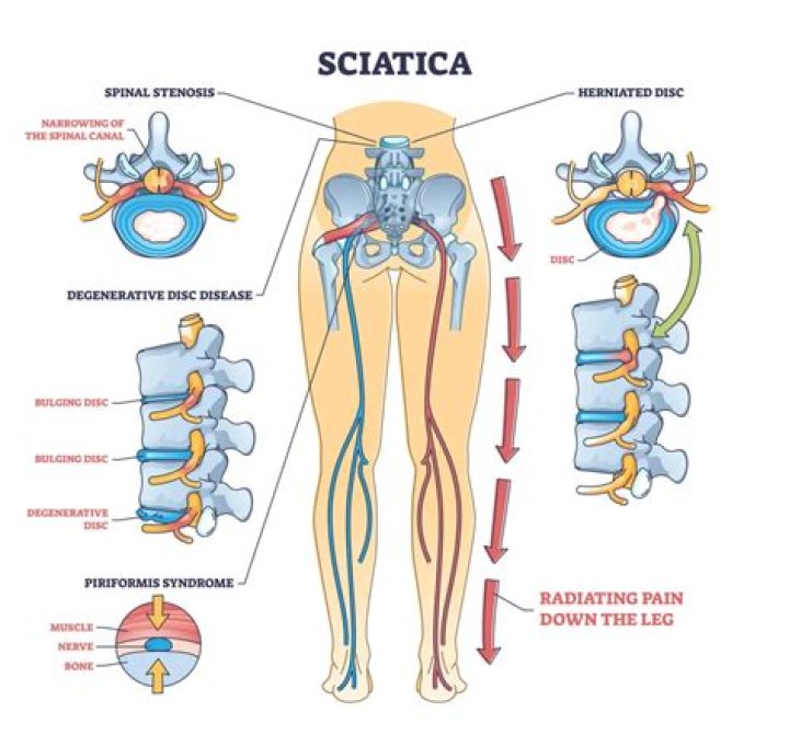 Can sciatica affect your ovaries?