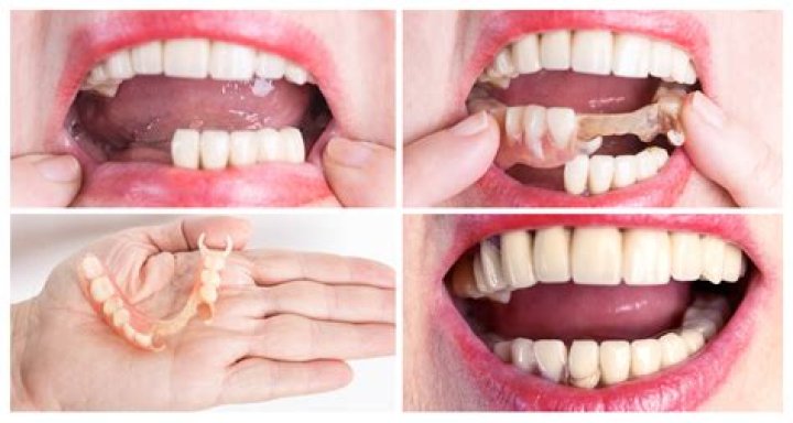 Do partial dentures look natural?