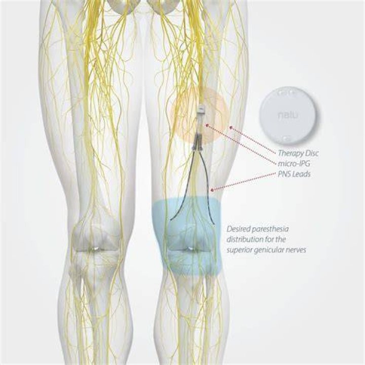 Does a nerve stimulator hurt?