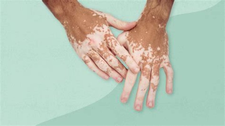 Does vitiligo happen in animals?
