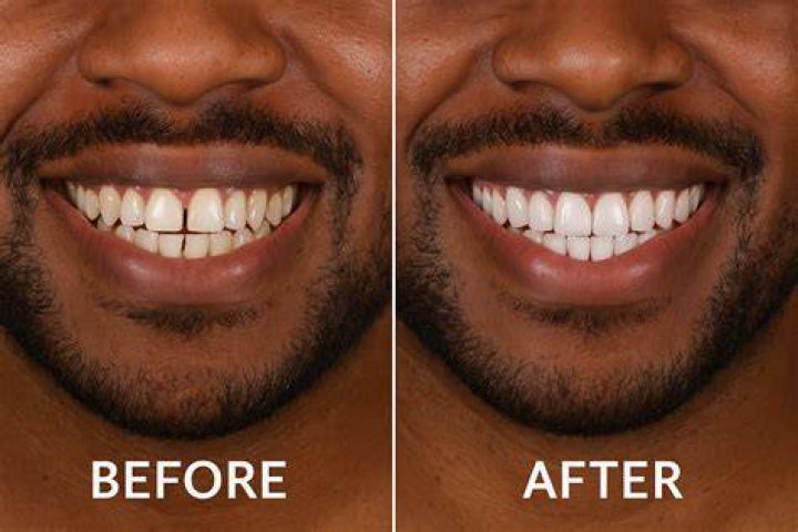 How much are dental veneers in Poland?