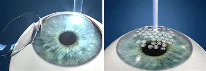 What is C LASIK?
