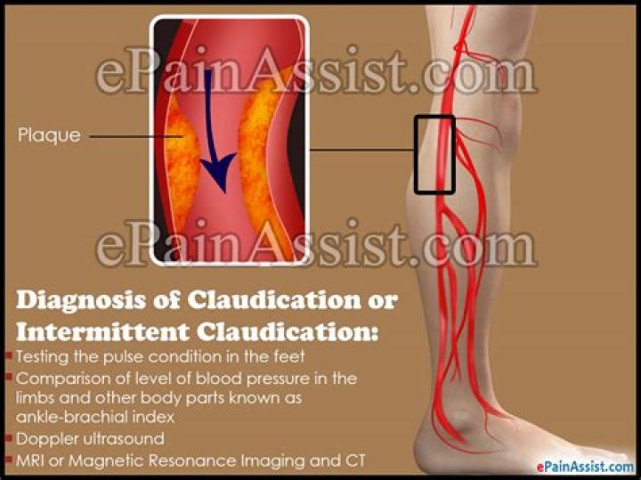 What is the diagnosis code for claudication?