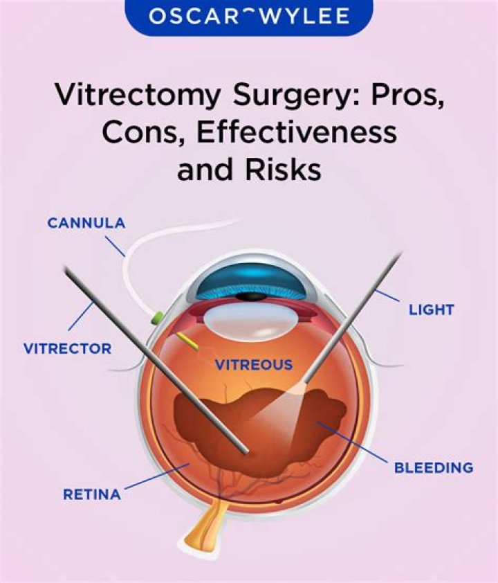What should I do after vitrectomy surgery?