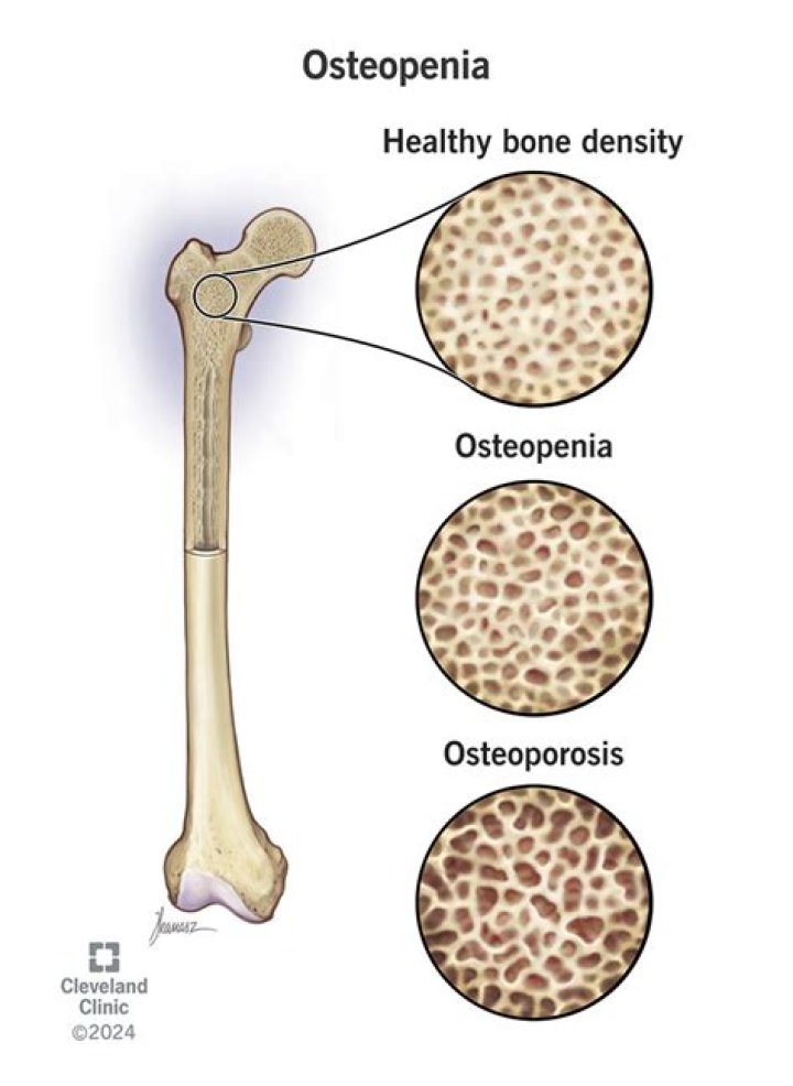 When does osteopenia require treatment?